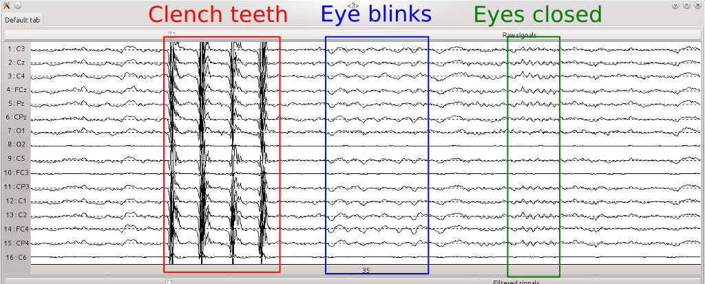 Nice artifacts and basic EEG activity that you should see before proceeding further on.